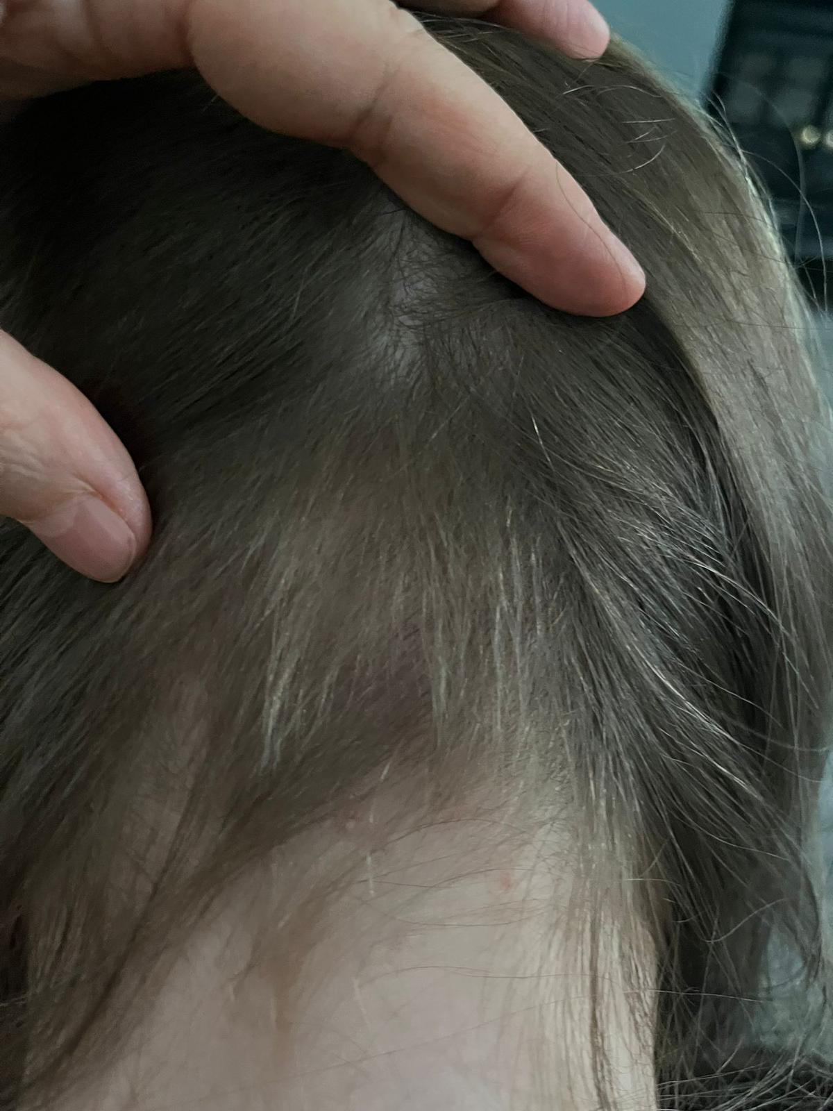 Hair Loss Treatment 